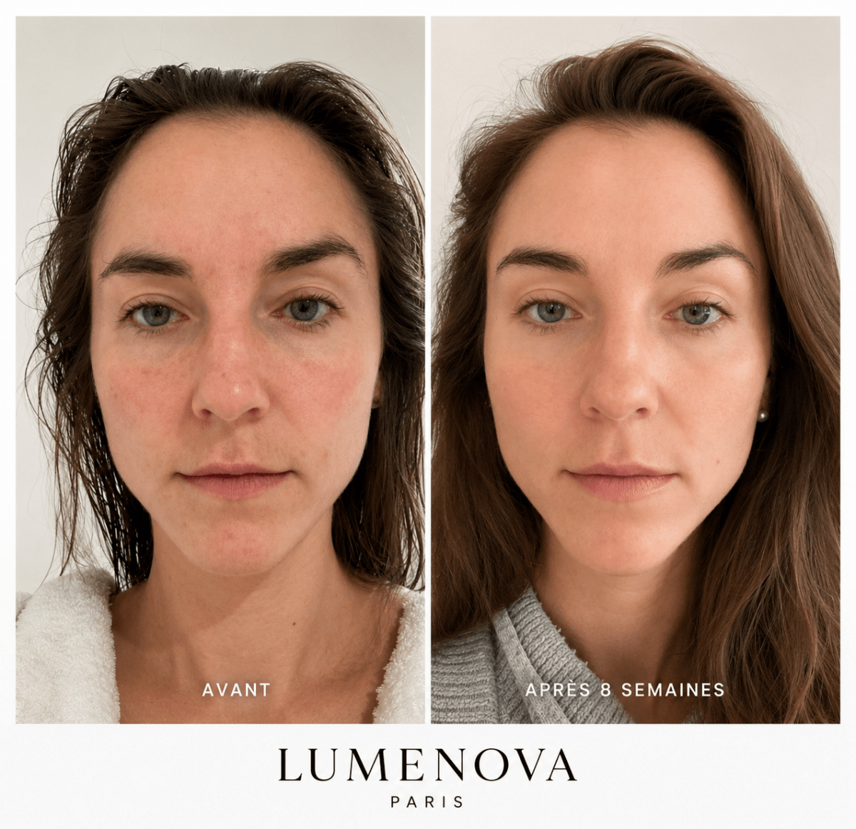 Résultats masque led visage avant après 4 semaines anti-acné Lumenova Paris