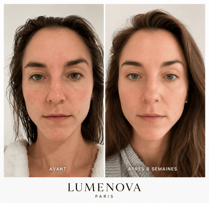 Résultats masque led visage avant après 4 semaines anti-acné Lumenova Paris